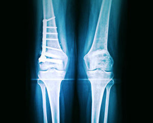 Osteotomia Femoral - Raio-x Pós-cirúrgico