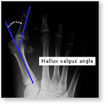 http://www.mdmercy.com/footandankle/conditions/bigtoe/images/valgus_bunion_4.jpg