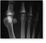 http://www.mdmercy.com/footandankle/conditions/bigtoe/images/osteotomy.jpg