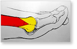 http://www.mdmercy.com/footandankle/conditions/bigtoe/images/valgus_bunion_6.jpg