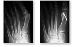 http://www.mdmercy.com/footandankle/conditions/bigtoe/images/valgus_bunion_8_9.jpg