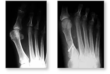 http://www.mdmercy.com/footandankle/conditions/bigtoe/images/valgus_bunion_11_12.jpg
