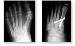 http://www.mdmercy.com/footandankle/conditions/bigtoe/images/valgus_bunion_16_17.jpg
