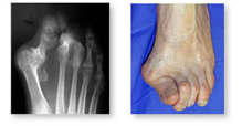 http://www.mdmercy.com/footandankle/conditions/bigtoe/images/straight.jpg